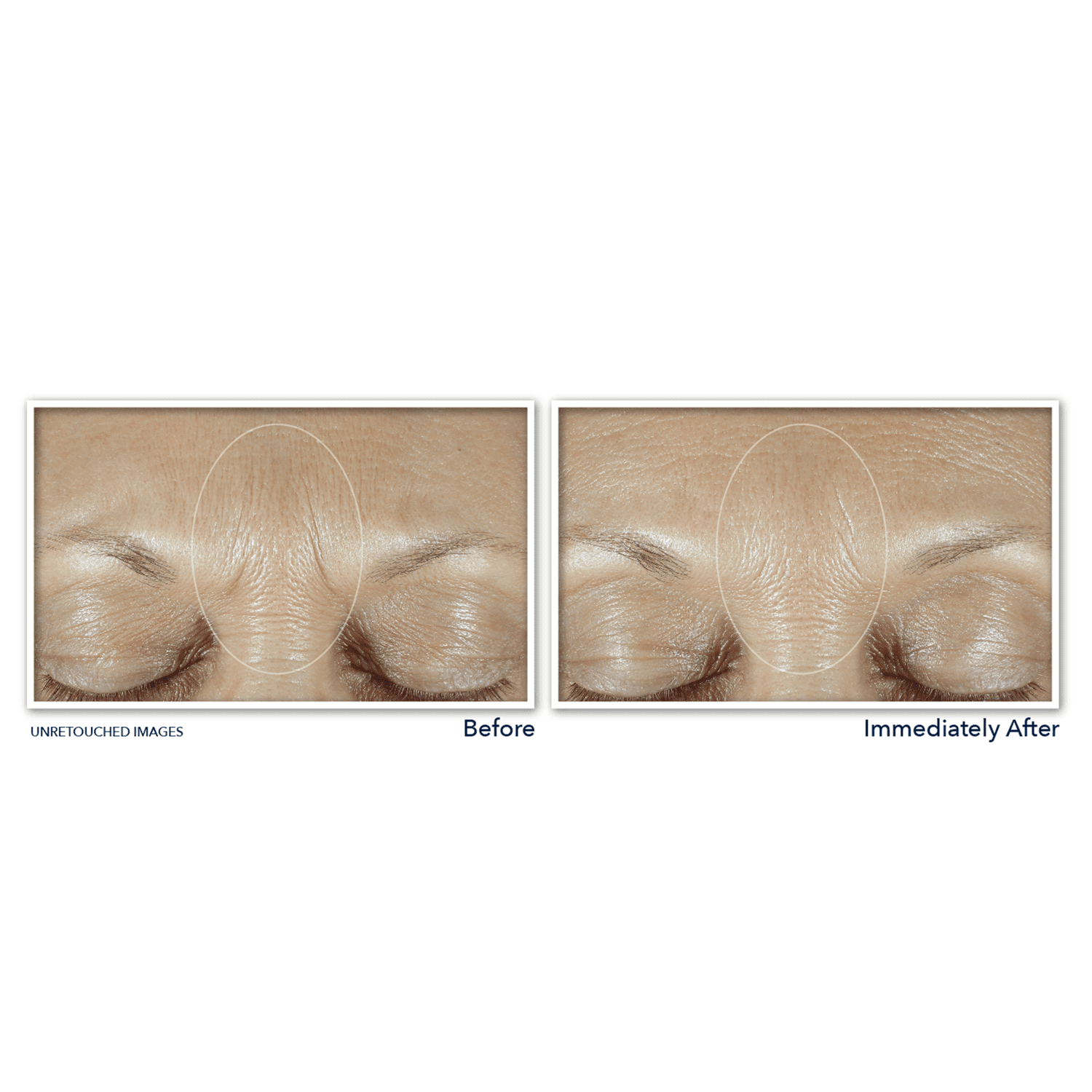 RoC Derm Correxion Fill and Treat Face Serum Refill with Retinol and Hyaluronic Acid, 0.34 fl oz