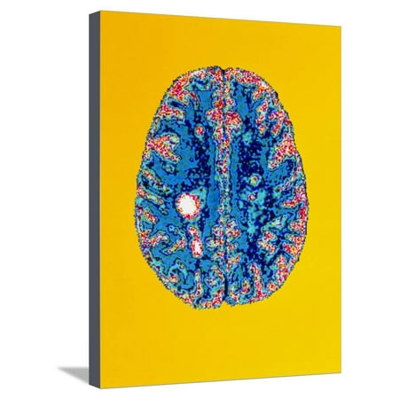 Col. MRI Scan of a Brain with Multiple Sclerosis Stretched Canvas Print Wall Art By Science Photo (Best Way To Scan Multiple Photos)
