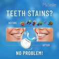 thumbnail image 3 of Professional Teeth Whitening Kit with Wireless Charging - Effective Teeth Whitening Solution, 3 of 5