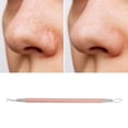 thumbnail image 5 of Unique Bargains 1 Pc Durable Double Headed Pimple Extractor Rose Gold Tone, 5 of 7