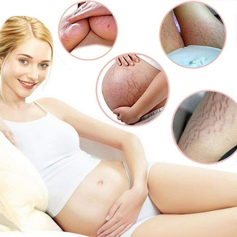 Placenta Life Removal Acne Scar Stretch Marks Cream Scar Placenta Life Removal Acne Scar Stretch Marks Cream Scar