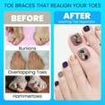 thumbnail image 3 of Toe Separators to Correct Bunions,Bunion Corrector for Women Men Overlapping Toes,Toe Straightener to Improve Functional Athletic Mobility - Stretches to Fit, 3 of 7
