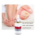 thumbnail image 3 of Tratamiento de hongos en las uñas Esencia para el cuidado de los pies Blanqueamiento de uñas y pies Eliminación de hongos en las uñas de los pies Gel Antiinfección Paroniquia Onicomicosis, 3 of 6