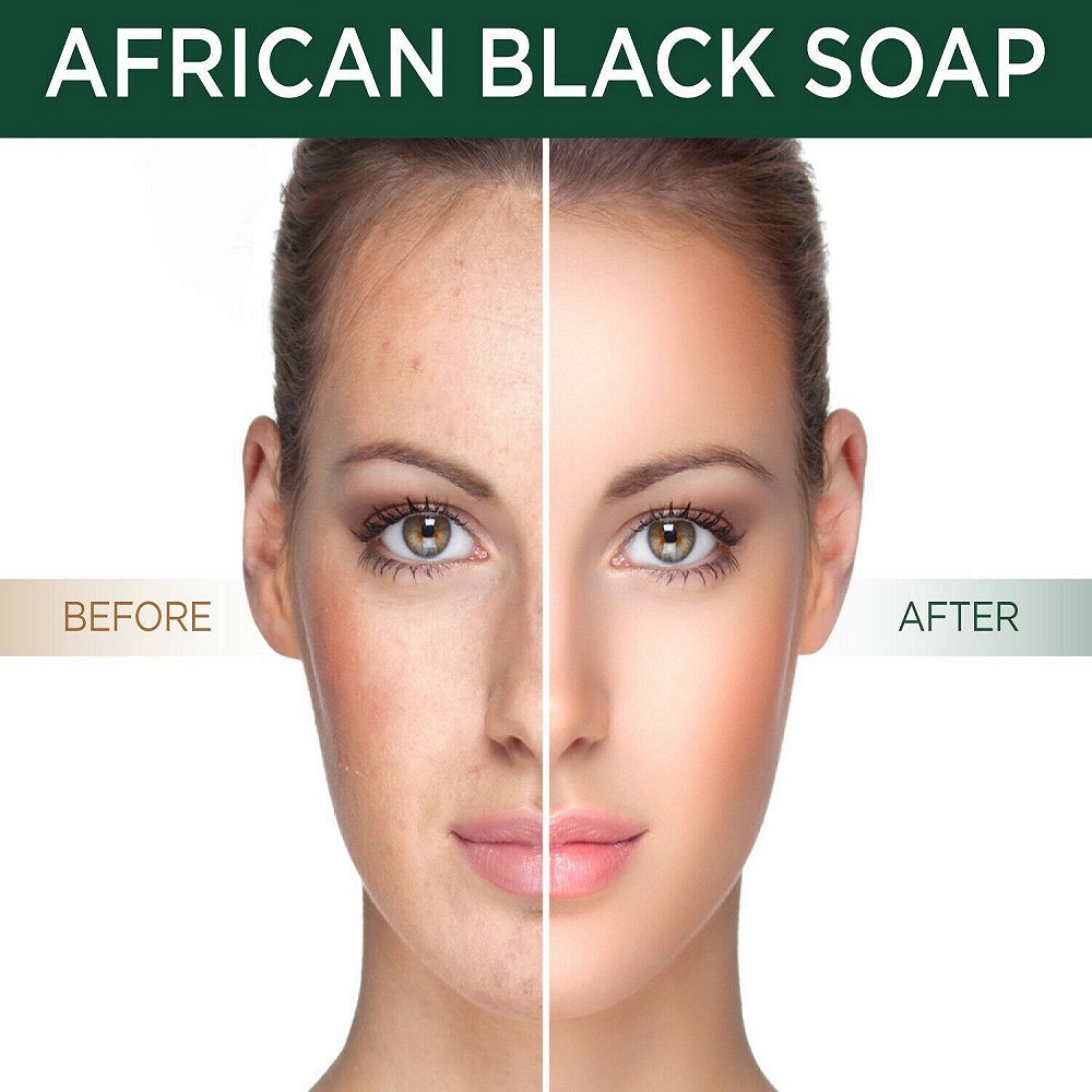 best acne treatment for blackheads