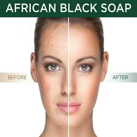 African Black Soap All Natural Best Acne Scar Blemish Blackhead Treatment (Best Way To Rid Blackheads)
