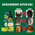 thumbnail image 2 of Aceite esencial de jengibre para el cabello anticaída serum tratamiento para la caída del cabello y adelgamiento promueve la regeneración del cabello unisex CAIXIN Jengibre cuidado del cabello aceite esencial, 2 of 6