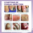 thumbnail image 2 of Jaysuing-Spray reparador de uñas, antiinfecciones, paroniquia, tratamiento antimicótico, cuidado de pies y manos |, 2 of 3
