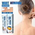 thumbnail image 2 of Wart removal cream 20Fast-acting gel warts ACareOintment suitable for face, hands, feet and body, 2 of 5