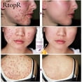thumbnail image 5 of Honey Acne Extract Acne Removal Marks Facial, 5 of 5