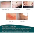 thumbnail image 3 of Silicone Plasters For Scars, Silicone Scar Films For Surgeries, Caesarean Section, Keloids, Burns,silicone Scar Tape-4cm*3m, 3 of 5
