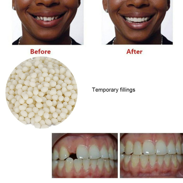 ANGGREK 2pcs 50g False Teeth Solid Glue Temporary Tooth Repair Gaps Filling  Teeth Care Tool,Temporary Tooth Repair,Teeth Gaps Filling 