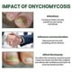 thumbnail image 4 of EELHOE Anti Fungal Treatment Fungus Effective Finger Toe Nail Repair Li, 4 of 4