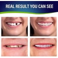thumbnail image 4 of Fake Teeth, 1 Pair of Dentures for Women & Men, Dental Veneers for Temporary Teeth Restoration, Comfortable and Natural, 4 of 5