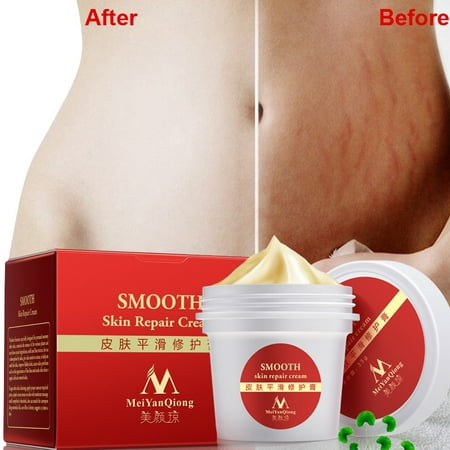 SUPERHOMUSE Smooth Skin Cream Stretch Marks Scar Removal Maternity Skin Repair Body Cream Remove Scar