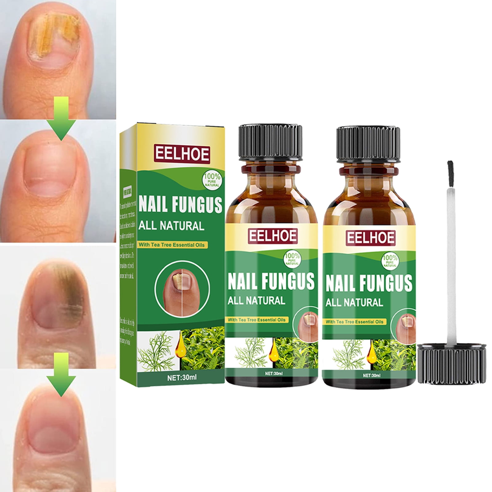Toenail Fungus Treatment, Effective Nail Fungus Treatment for Toenail
