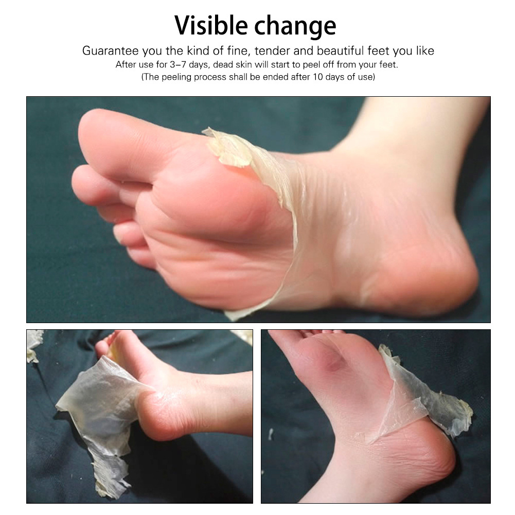 peel foot skin