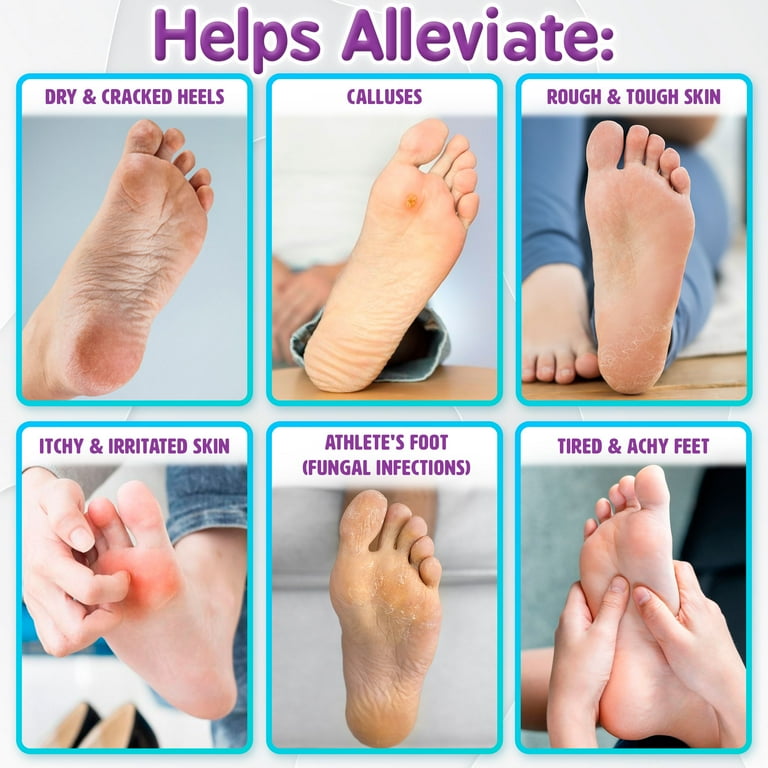 Fungal Infection Dry Cracked Bleeding Heels Juvenile Plantar