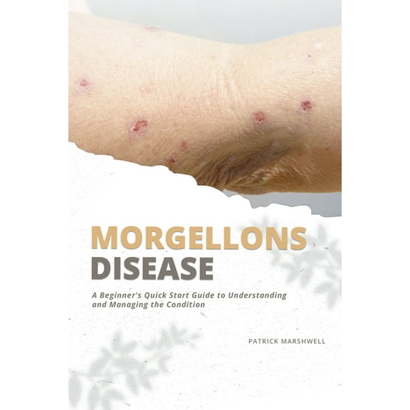 Morgellons Disease: A Beginner's Quick Start Guide to Understanding and Managing the Condition, (Paperback)