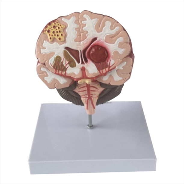 Modelo de Enfermedad del Cerebro Humano - Patología Cerebral Hemorragia del Encefálico Modelo de Enseñanza Médica - Modelo de Anatomía del Cerebro Humano