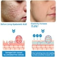 thumbnail image 5 of Système de Micro-Infusion pour les Lèvres, Aiguille Hydra de Micro-Infusion, Micro Système pour le Visage, Système Facial de Micro-Infusion avec Sérum, 5 of 5