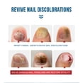 thumbnail image 3 of Suero De Uñas Líquido para el tratamiento de hongos, 10 ml, para aliviar la esencia de tratamiento de uñas encarnadas para el cuidado de los pies Sywqhk Cuidado Belleza, 3 of 8