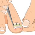 thumbnail image 3 of Ingrown Toenail Pedicure Tool 10Pcs/Bottle Straightening Clip Curved Bs Brace Toenails Thick Paronychia Correction Tool Foot, 3 of 5