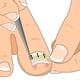 thumbnail image 3 of Ingrown Toenail Pedicure Tool 10Pcs/Bottle Straightening Clip Curved Bs Brace Toenails Thick Paronychia Correction Tool Foot, 3 of 5