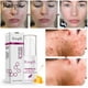 thumbnail image 1 of Miel Extracto De Acné Eliminación De Marcas De Acné Facial, 1 of 4