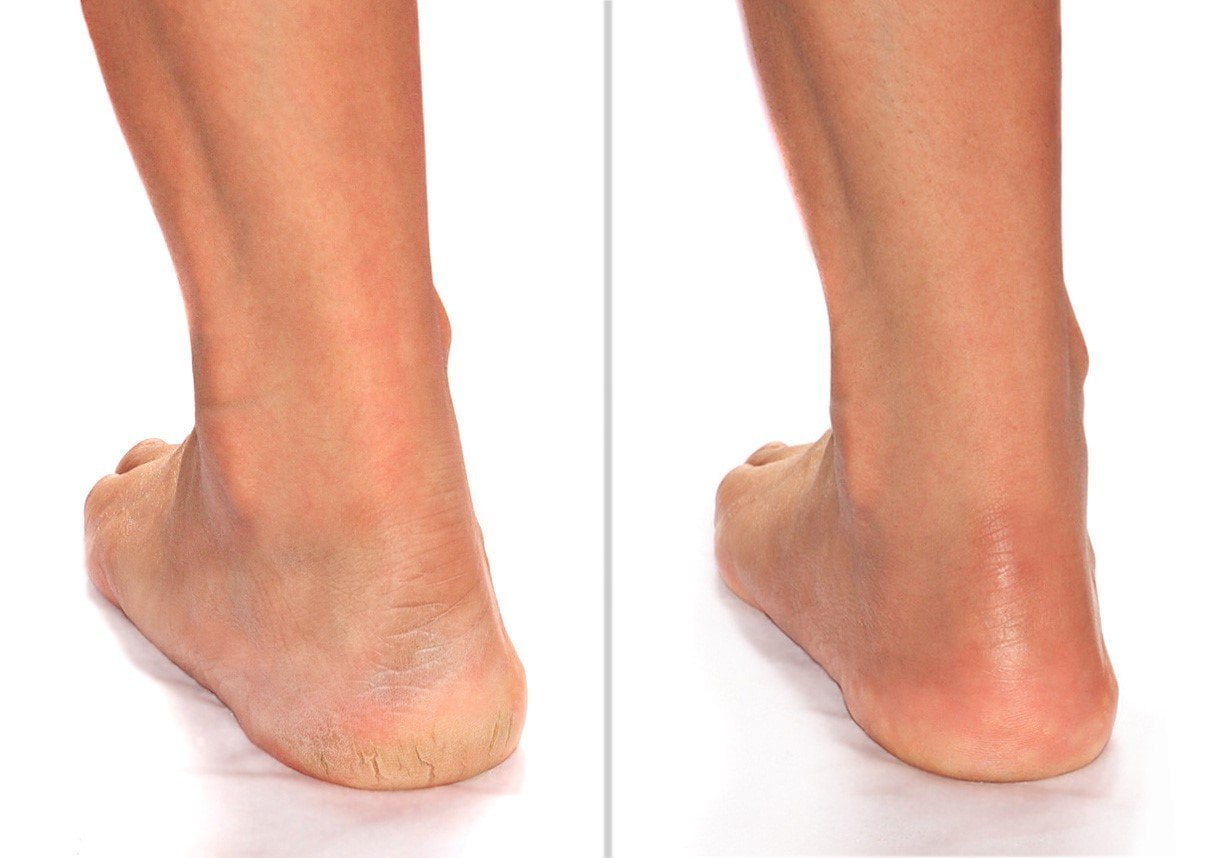 Advanced clinicals cracked heel cream discount