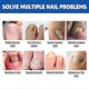 thumbnail image 4 of Jaysuing nail groove care patch repair thickened onychomycosis soft nail correction nail groove ingrown toenail nail correction patch |, 4 of 5