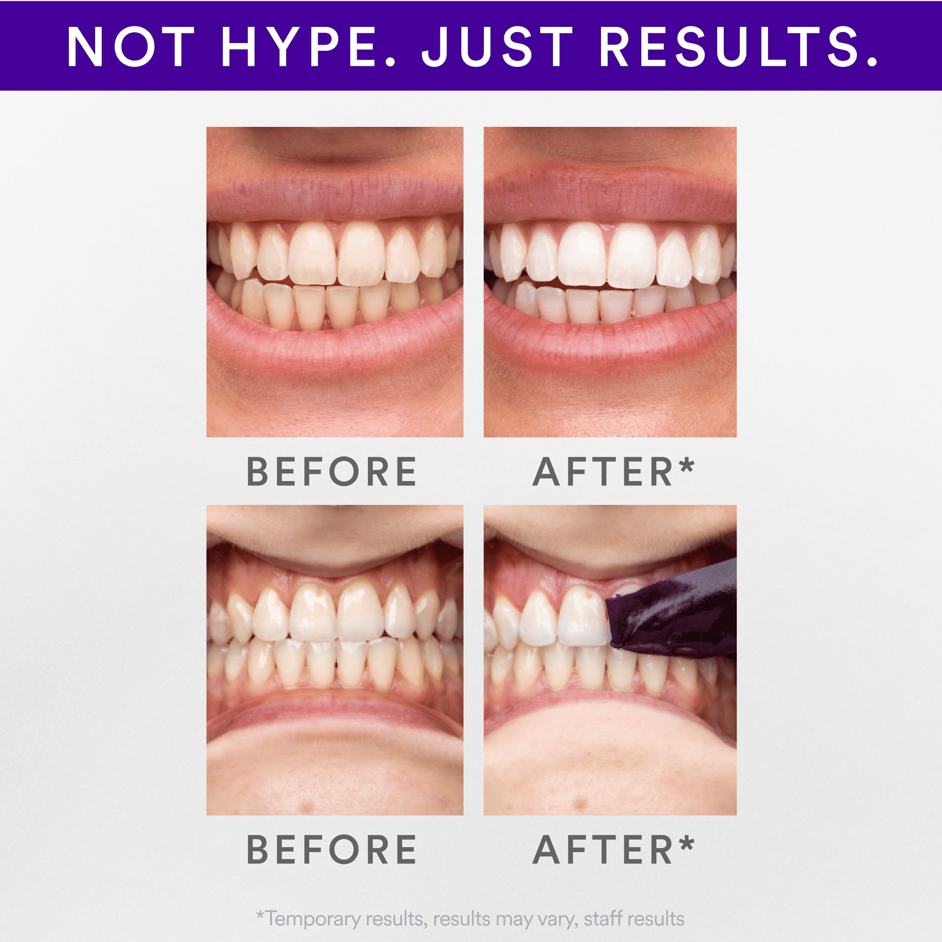 Hismile V34 Teeth Whitening Strips 14pk