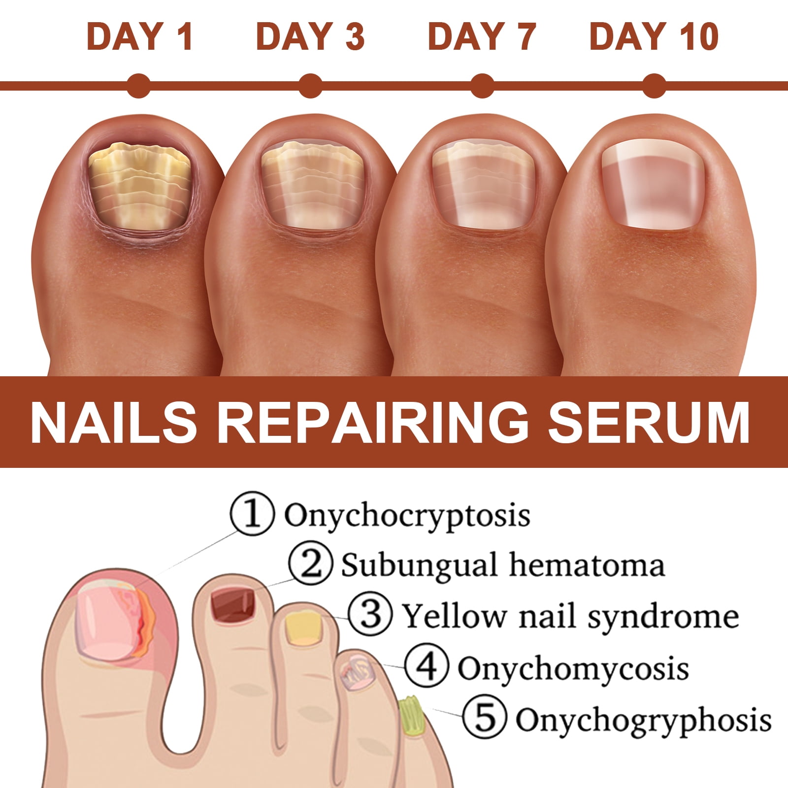 Alvantor 7-Day Nail Treatment Serum for Antifungal , Damaged Discolored Thick Nails, ToeNail Nourishing Essence, 0.68fl.oz