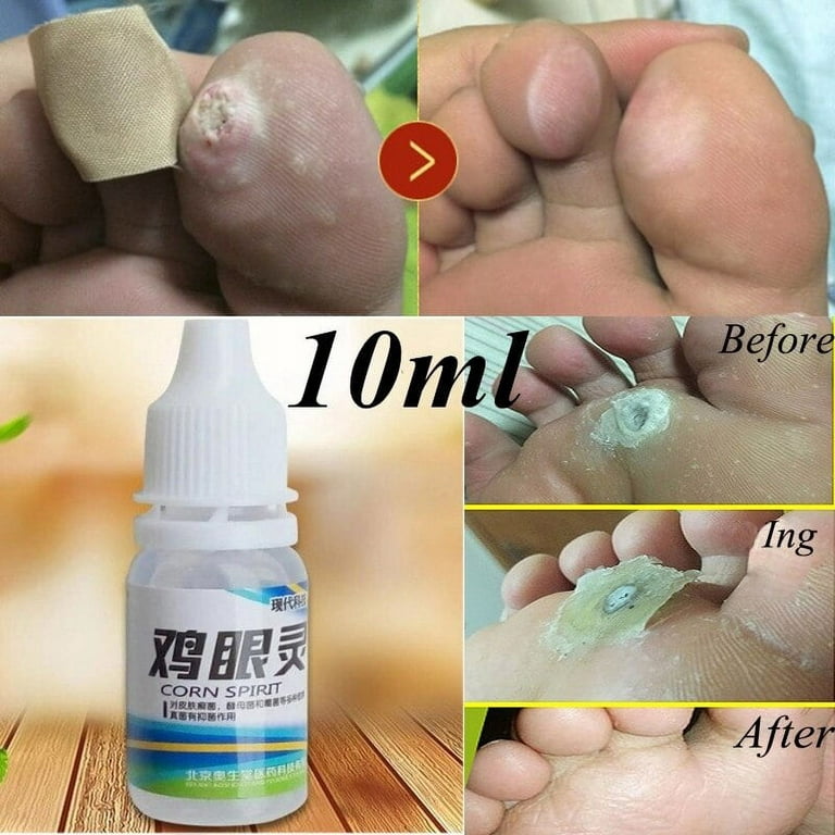Powerful Foot Corn Remover Useful Foot Callus Remover Liquid 10Ml