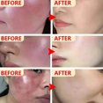 thumbnail image 2 of Crema reparadora de rojeces faciales, loción hidratante para mejorar la Rosacea Sooth, barrera de reparación de la piel sensible a la picazón, Cosméticos coreanos, nueva, 2 of 5