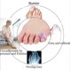 thumbnail image 2 of ZHAOCHENG Férula para dedo meñique, separador de gel para dedos, enderezador para dedo meñique (morado), paquete de 10, 2 of 5