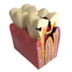 thumbnail image 2 of Modelo De Herramienta De Enseñanza Cariados Dispensión Gingival Modelo 2 DYNWAVEMX Molde de estudio de compactación de caries, 2 of 5