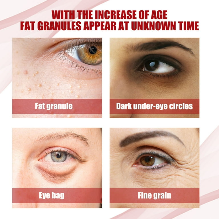 Xerdsx Speedy Milia Remover 30ml Milia Remover Under Eyes Organic Skin Spot Purifying Serum Speedy Milia Remover