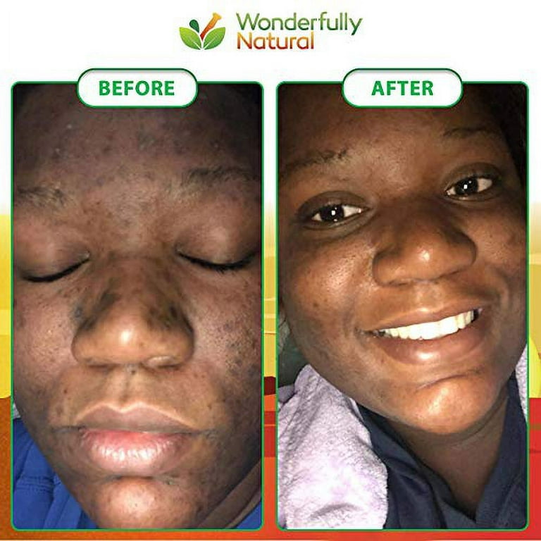 Organic African Black Soap For Acne Dark Spots Natural Vegan