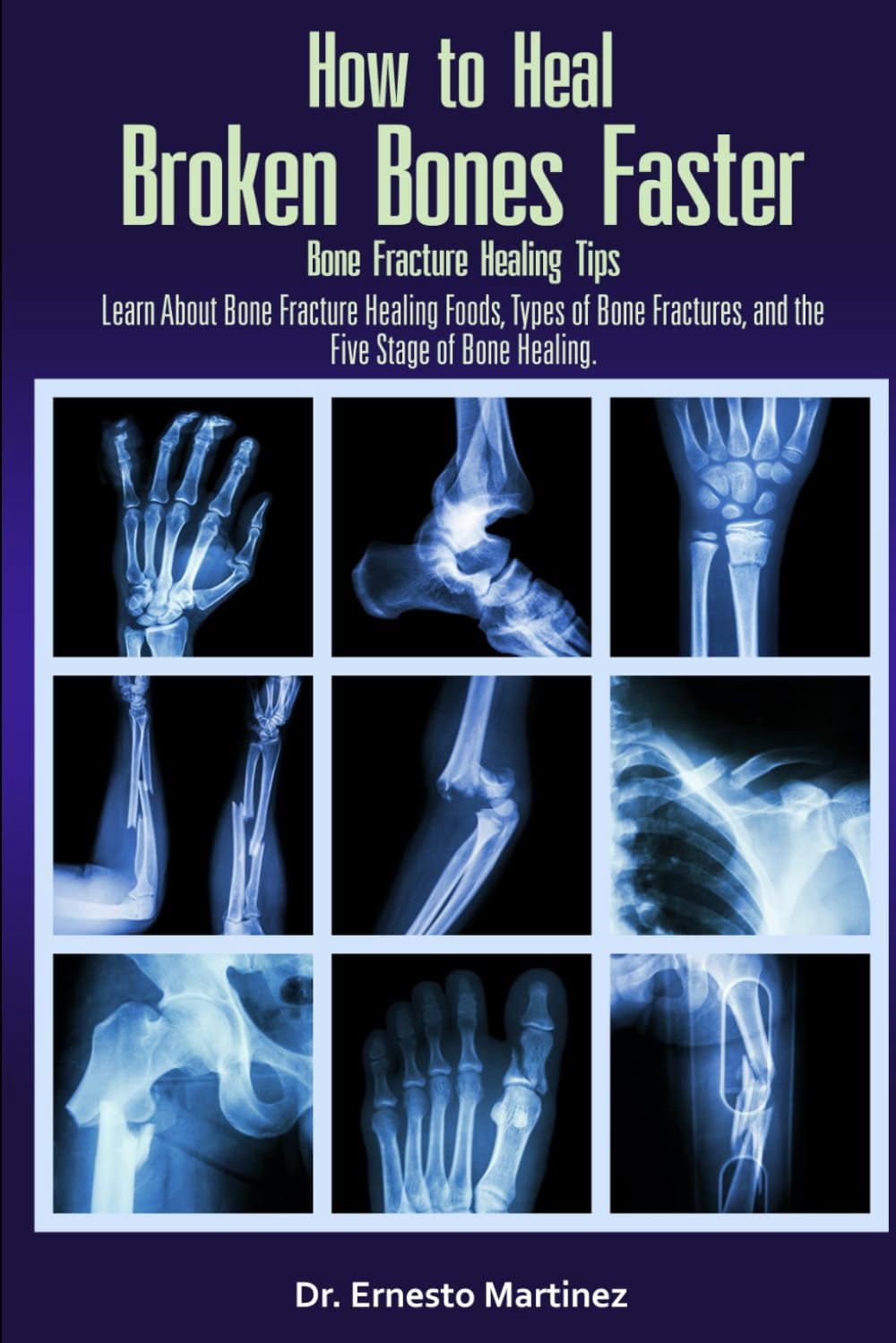 Pre-Owned How to Heal Broken Bones Faster. Bone Fracture Healing Tips ...