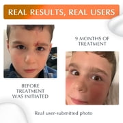 NewGel+ UV by MyNewGel Silicone Scar Gel + SPF30, Sun Protection & Scar Care, 15 g