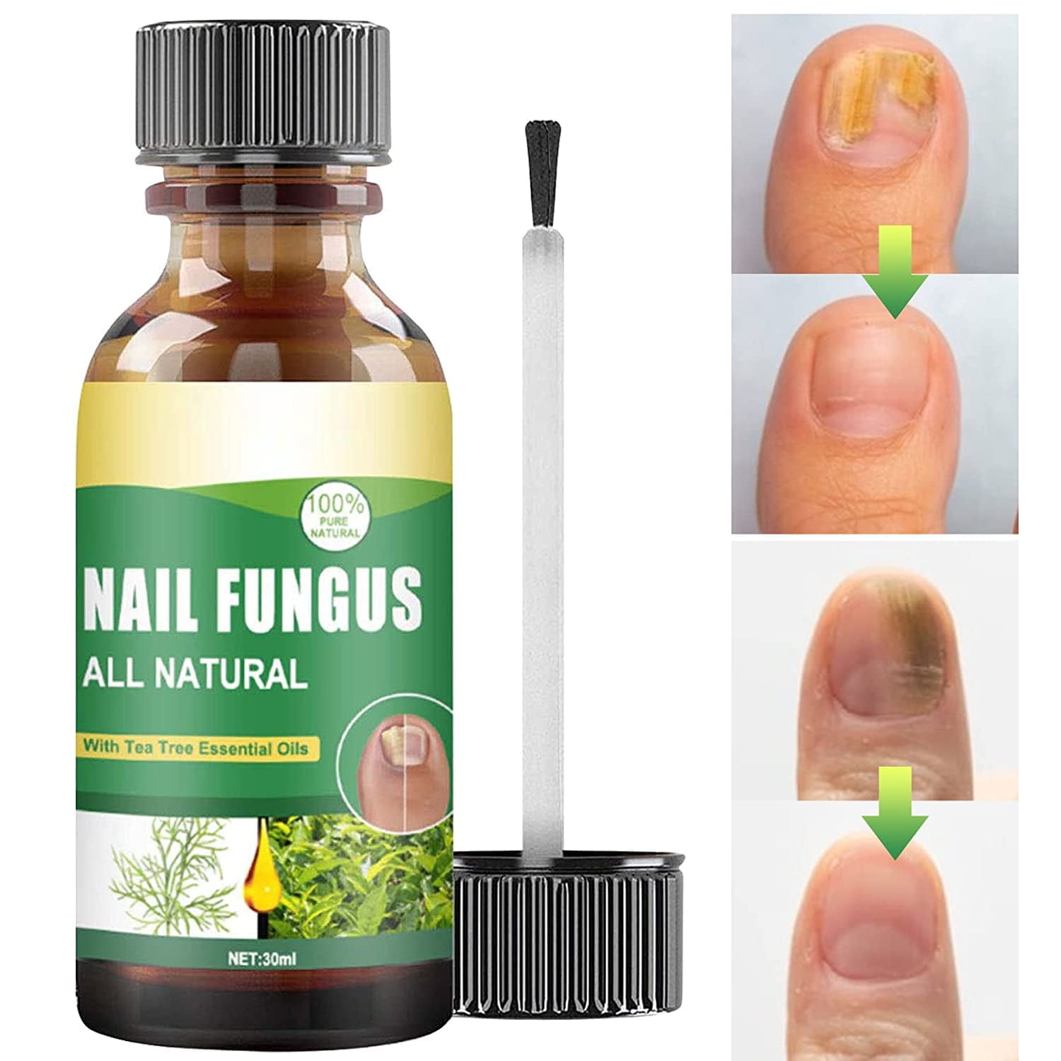 Toenail Fungus Treatment, Effective Nail Fungus Treatment for Toenail