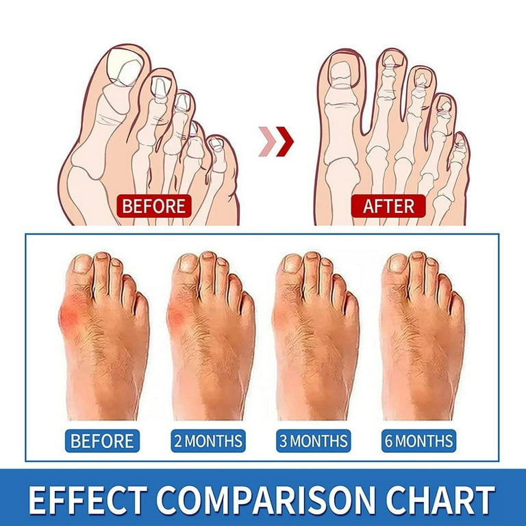 Bunion Splint Before And After Pictures HighQuality Sale alumni.uod.ac