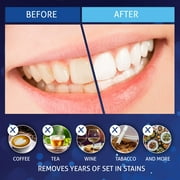 MagicBrite Complete Teeth Whitening Kit 2 Carbamide Peroxide Whitening Gel Pens with 1 LED Light At Home Whitening