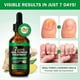 thumbnail image 2 of 1/2/3PCS Nail Fungus Treatment, Ginger Nail Fungus Treatment, Toenail Cuticle Care Oil Care, Fungal Nail Treatment, 7 Days Nail Fungus Treatment, 2 of 5