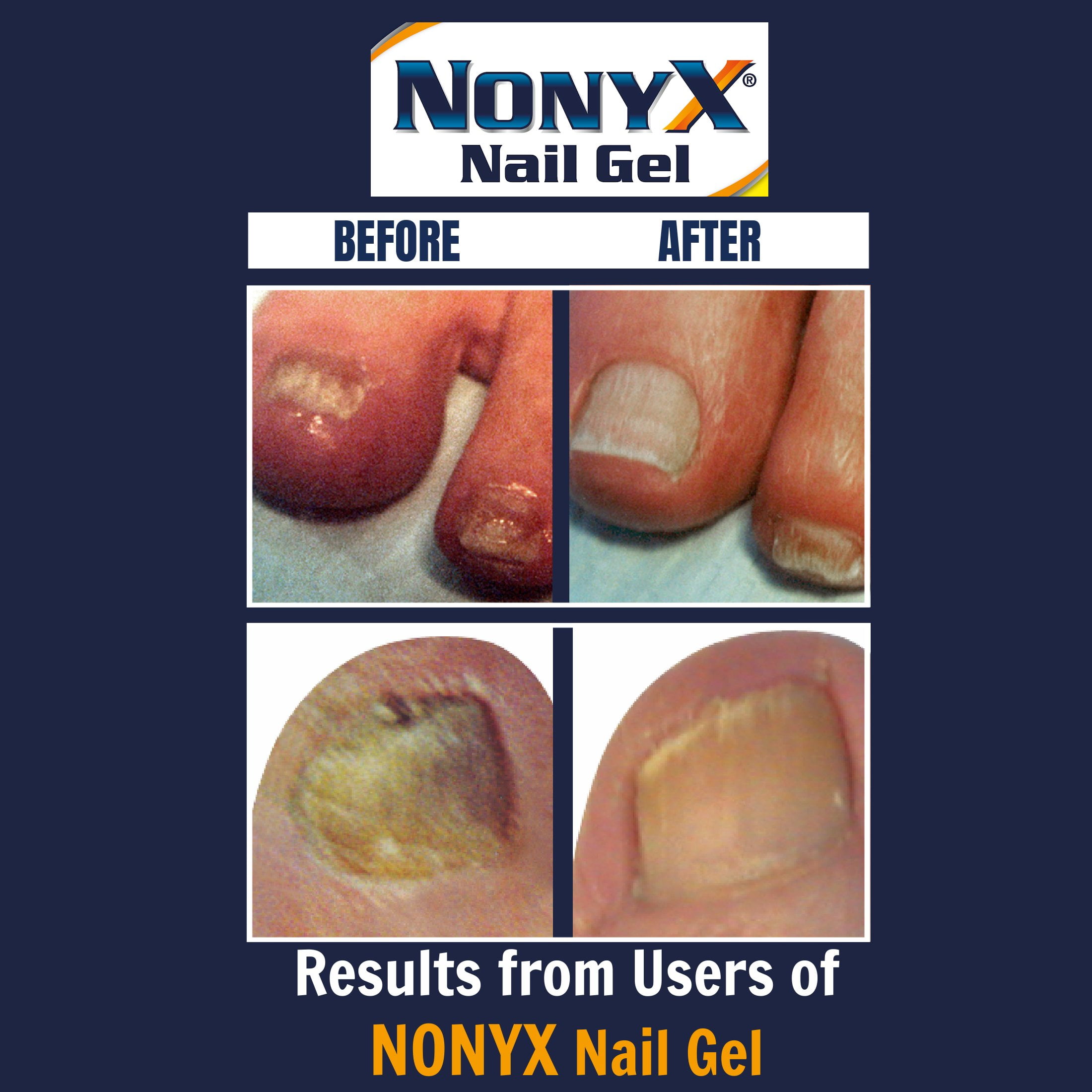 NonyX Fungal Nail Clarifying Gel, 4 oz