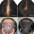 thumbnail image 4 of HairMax Ultima 12 LaserComb Appareil de Croissance Capillaire à Domicile. 12 Lasers de Qualité Médicale. Stimule la Pousse des Cheveux, Inverse l'Amincissement, Repousse des Cheveux Plus Denses, Cheveux Plus Fournis. Traitement Ciblé de la Perte de Cheveux., 4 of 8