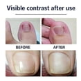 thumbnail image 2 of 2026 2packs Fungal Nail Treatment Patch, Nail Repair Patches Fungal Nail Repair Treatment, Repair Onychomycosis Fungal Nail Patches, 2 of 5