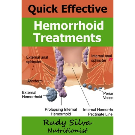 Quick Effective Hemorrhoid Treatments - eBook (Best Way To Heal Hemorrhoids)