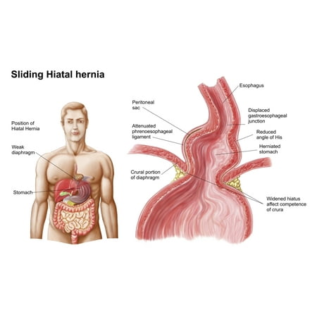 Medical ilustration of a hiatal hernia in the upper part of the stomach into the thorax Canvas Art - Stocktrek Images (18 x