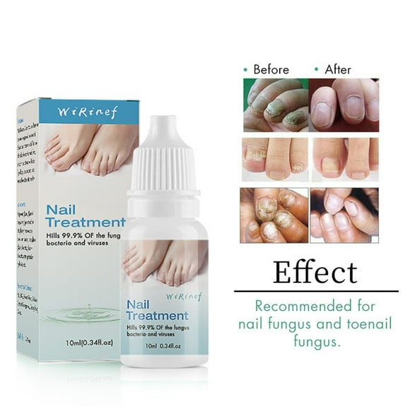 Cremas y lociones para pies, uñas, blanqueamiento de uñas y pies, eliminación de uñas de los pies, esencia para tratamiento de uñas de 10 ml